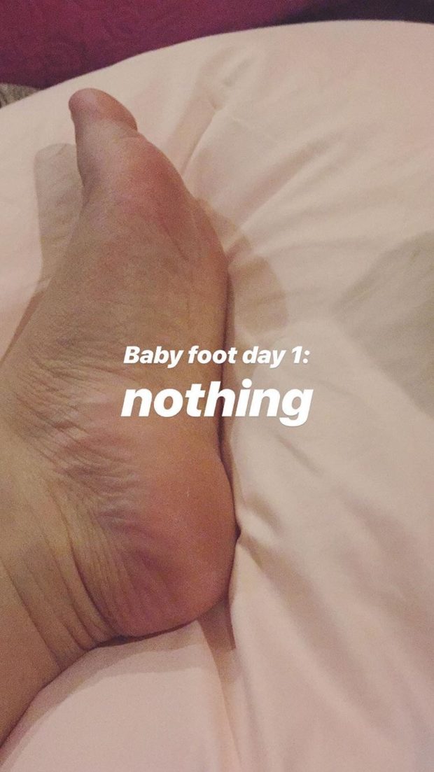 I Tried an Acid Foot Peel and It Was 
